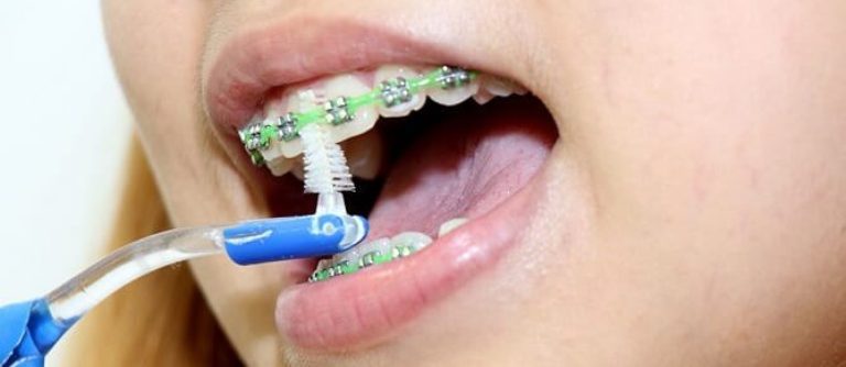 Ortodont higiena